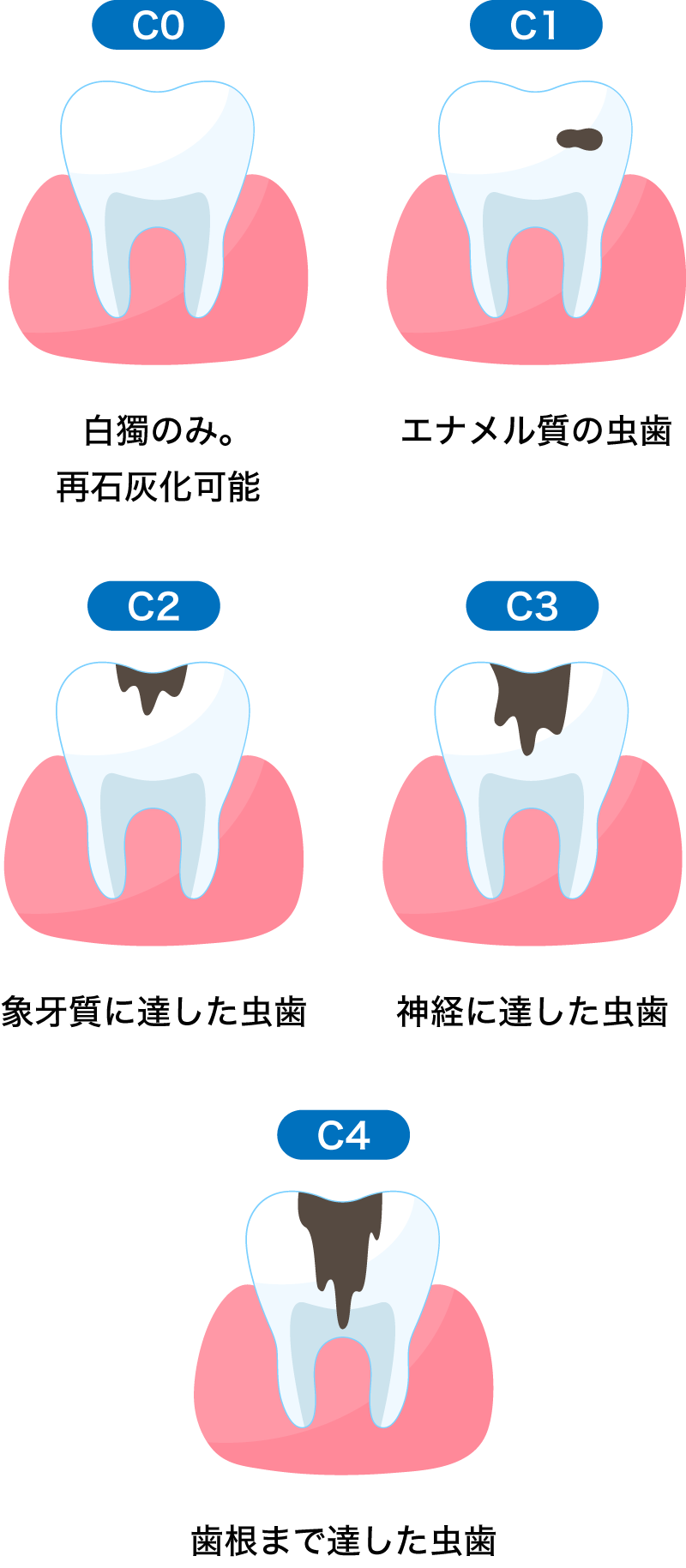 虫歯の治療 C0~C4までの図解